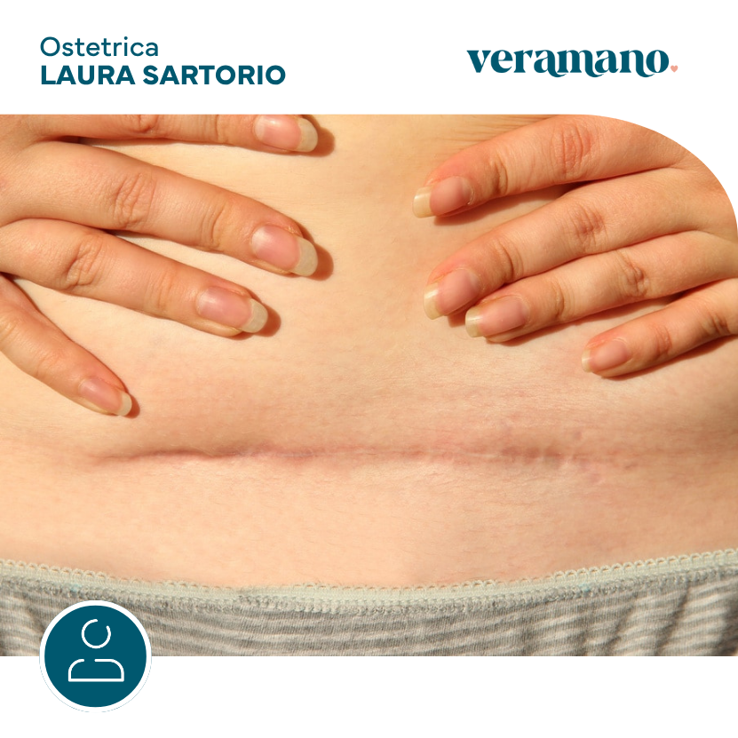 Trattamento cicatrice parto cesareo